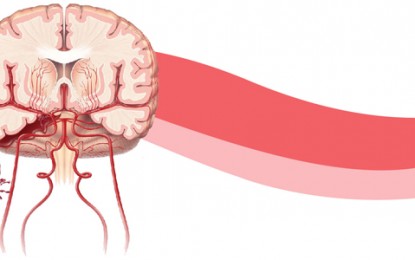 Aneurisma cerebral é conhecido por ser uma doença silenciosa