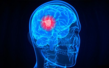 Gliobastoma é o tipo mais comum de tumor cerebral maligno