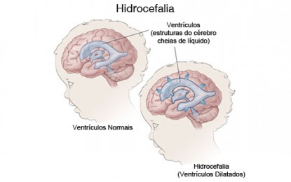 Doenças que a neurocirurgia pediátrica pode tratar