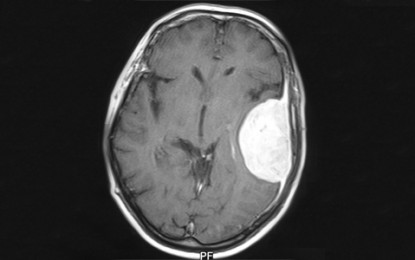 Meningioma cerebral cresce sem apresentar sintomas