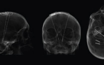 As doenças que a neurocirurgia funcional pode tratar