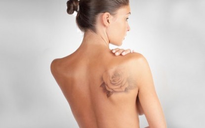 Como funciona a remoção de tatuagem