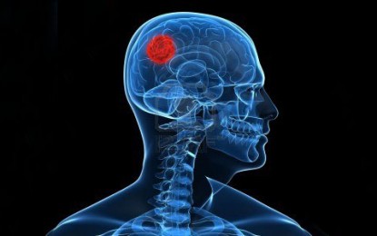 Tumor cerebral e formas de tratamento