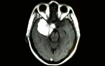Meningioma cerebral é o tumor que cresce a partir das meninges