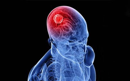 Conheça os tipos de tumores no cérebro e os seus tratamentos