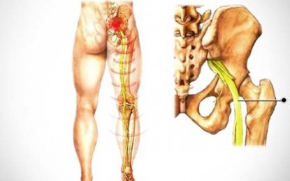 Saiba como evitar dores no nervo ciático