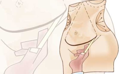 Abdominoplastia é alternativa para diminuir flacidez e gordura localizada