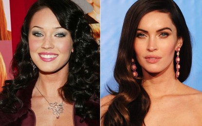 Bichectomia: Cirurgia para afinar rosto é tendência