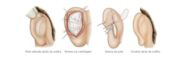 otoplastia01