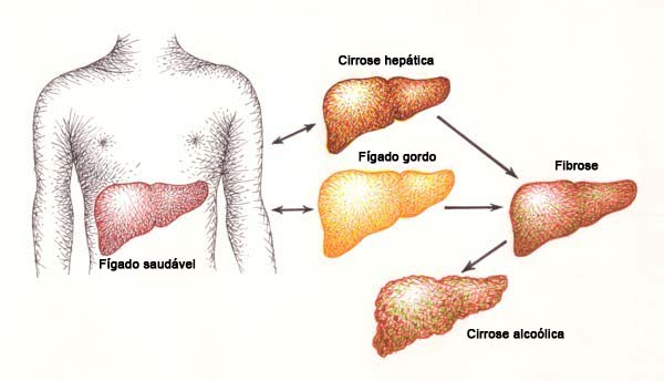 evolução da fibrose e cirrose alcoólica