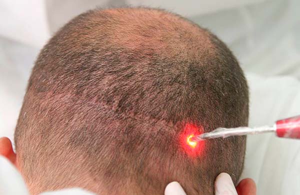 terapia capilar com laser e outros aparelhos