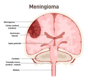 Meningioma: sintomas, diagnóstico e opções de tratamento