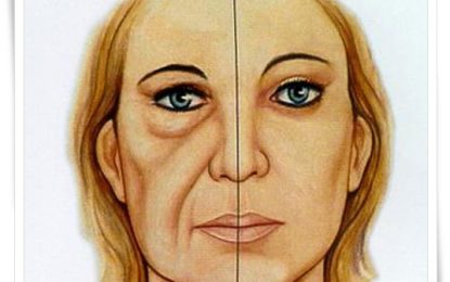 Tratamento para Bigode Chinês