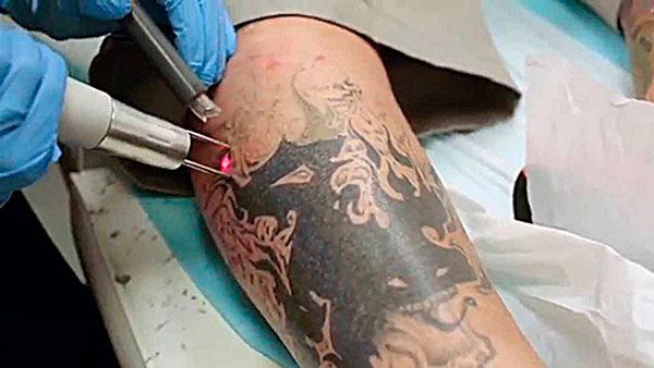 remoção de tatuagem sem cicatriz com fototormólise seletiva