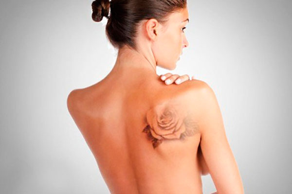 tatuagem parcialmente removida nas costas de uma mulher