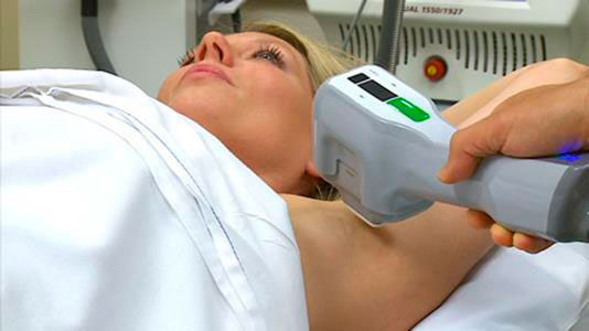 mulher recebe tratamento com miradry para parar de suar na axila