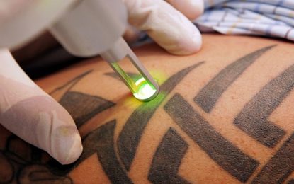 Remoção de tatuagem em São Paulo