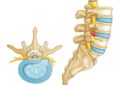 Ortopedista Especialista em Hérnia de Disco