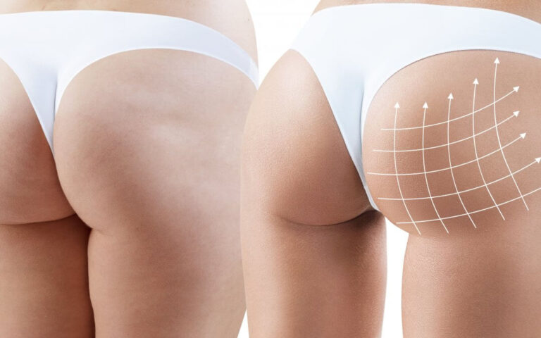 Harmonização Glútea com Bioestimulador de Colágeno